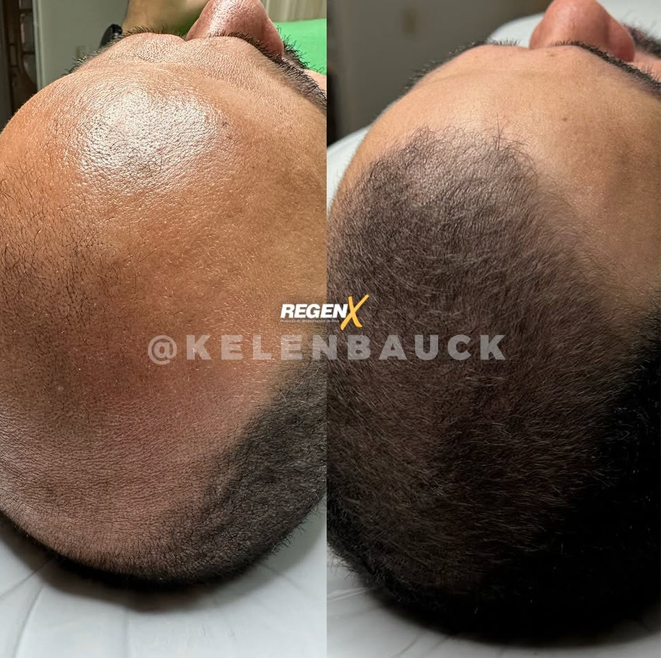 REGENX - Repousse Naturelle des Cheveux
