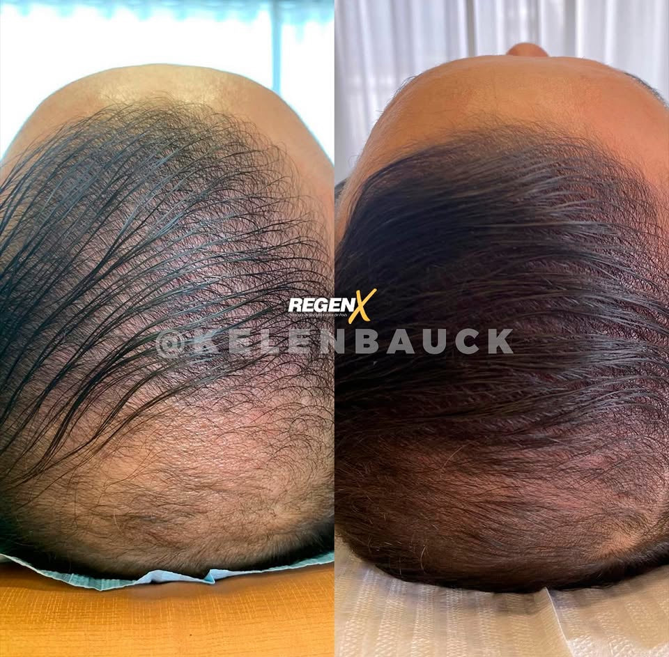 REGENX - Repousse Naturelle des Cheveux