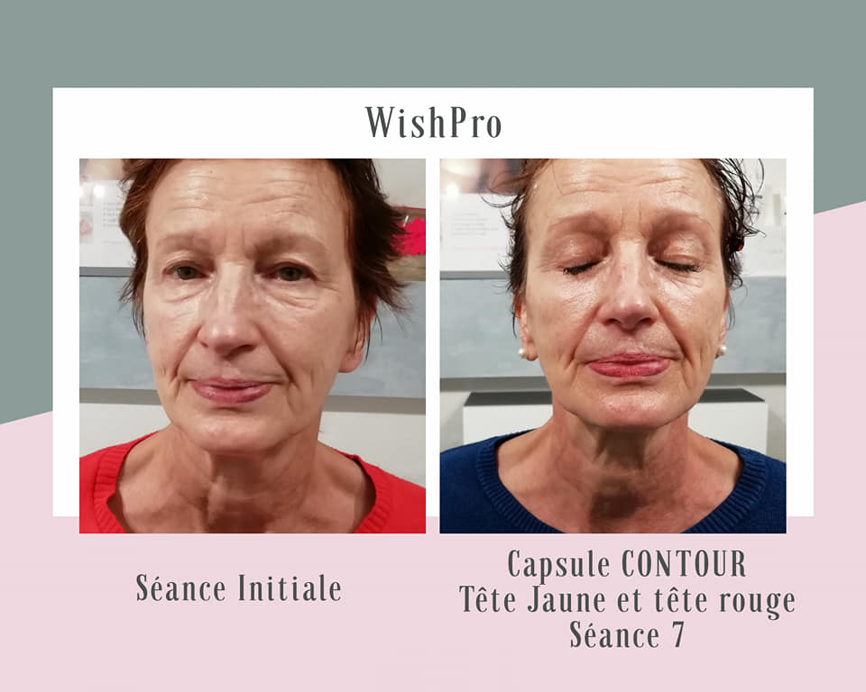 Soin anti-âge WISH PRO résultats spectaculaires Beauvais