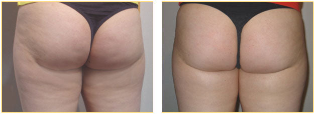 Vacustep Beauvais – Soin Minceur Anti-Capitons & Anti-Cellulite