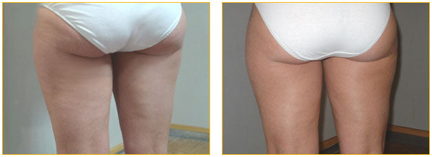 Vacustep Beauvais – Soin Minceur Anti-Capitons & Anti-Cellulite