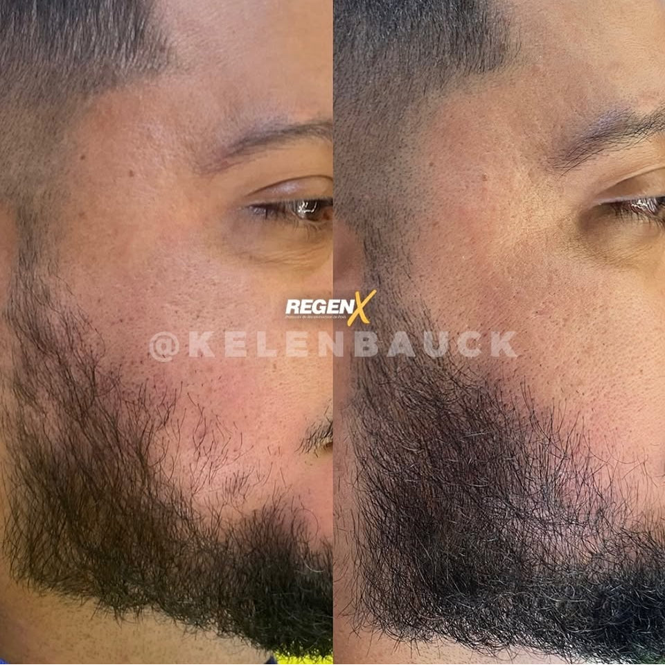 REGENX - Repousse Naturelle de la Barbe