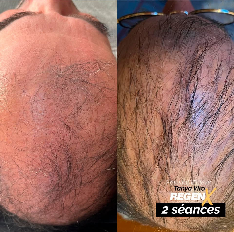 REGENX - Repousse Naturelle des Cheveux