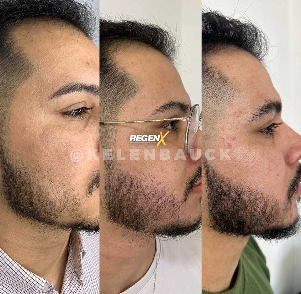 REGENX - Repousse Naturelle de la Barbe