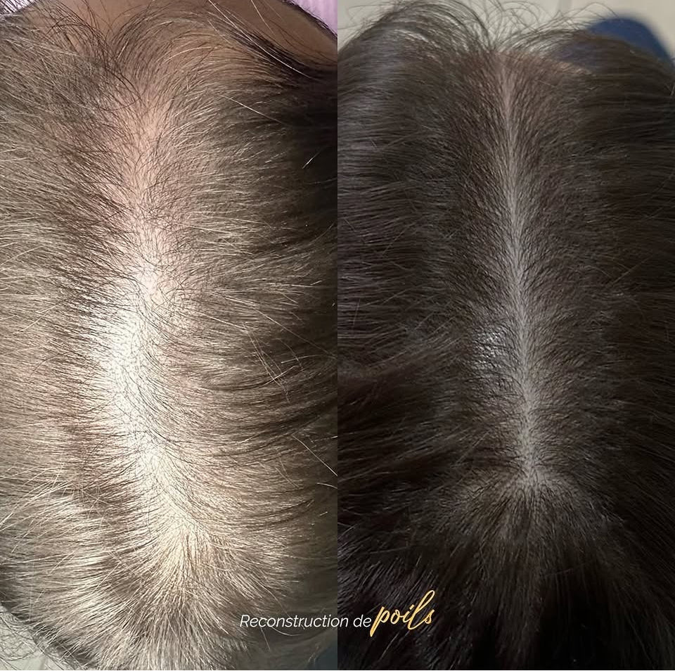REGENX - Repousse Naturelle des Cheveux