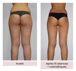 LPG Cellu M6 - La Révolution Minceur et Fermeté - Spa No Stress Beauvais