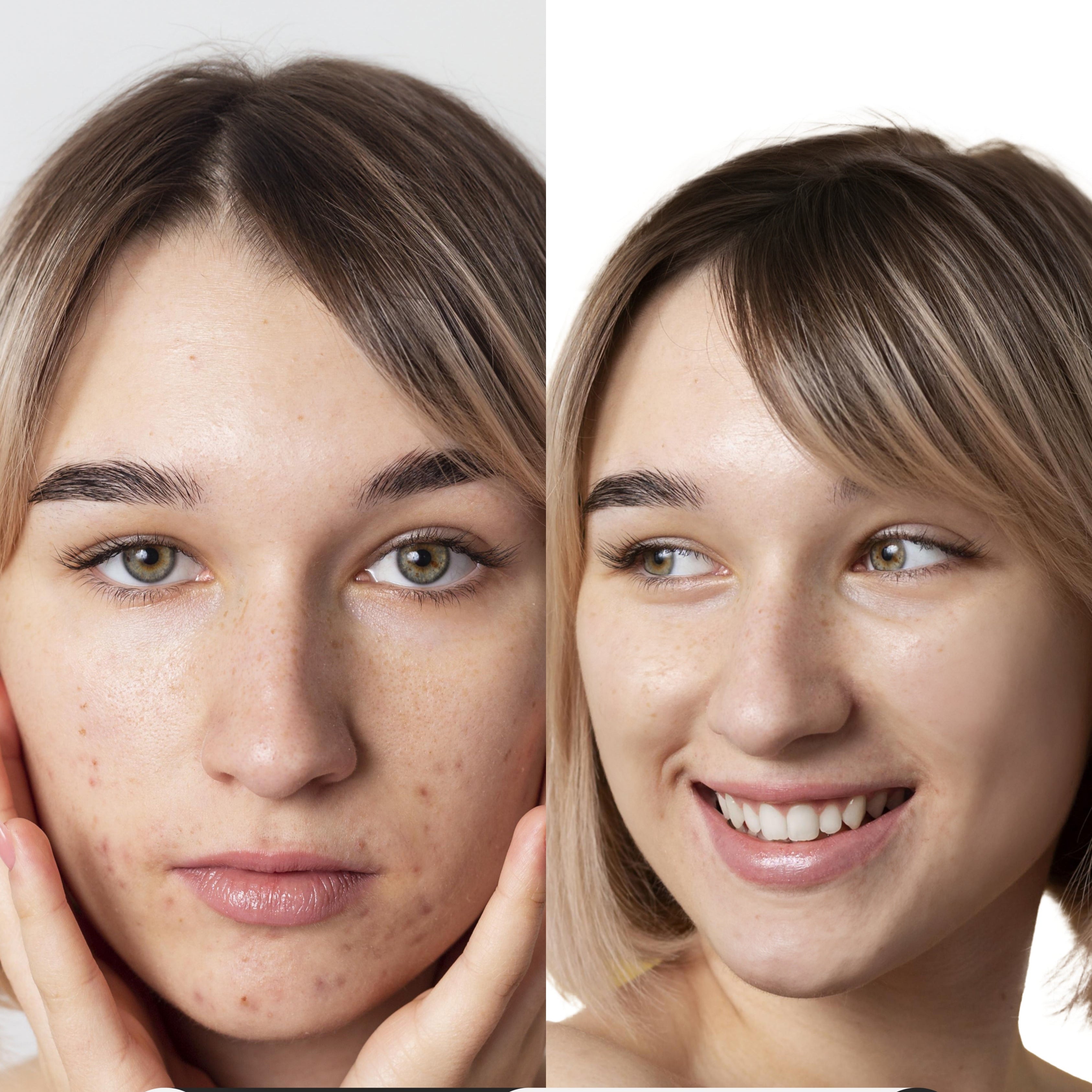 Soin HYDRA FACIAL 1 heure - innovation rénovateur de peau