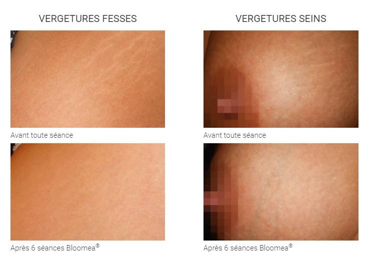 Soins Anti-Âge la Fontaine - taches, cicatrices, rides