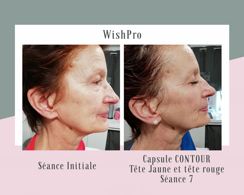 Soin anti-âge WISH PRO résultats spectaculaires Beauvais 