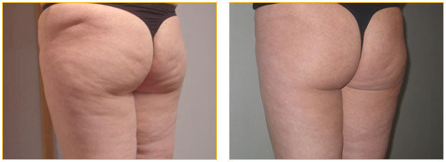 Vacustep Beauvais – Soin Minceur Anti-Capitons & Anti-Cellulite